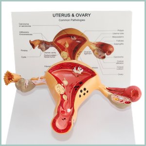 여성 자궁 및 난소 병리적 해부모형R