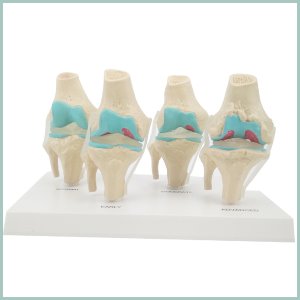 인체 무릎 관절염 4단계 모형R